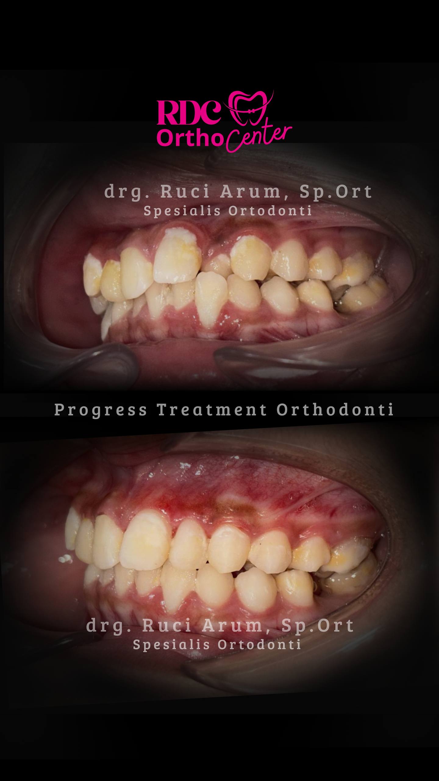 Behel Gigi / Ortodonti