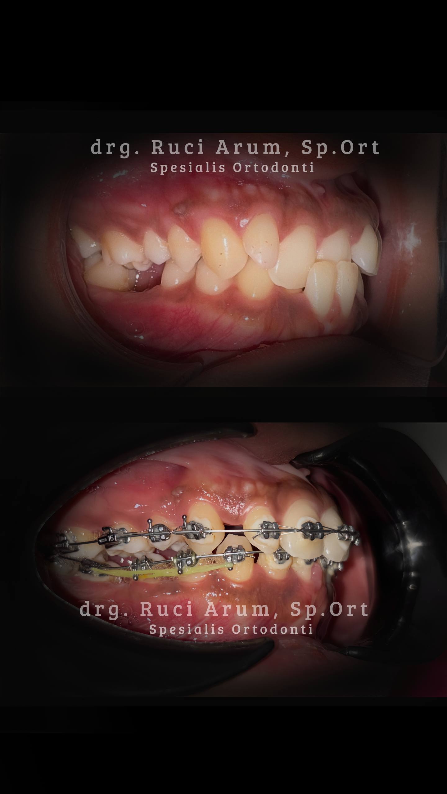 Behel Gigi / Ortodonti