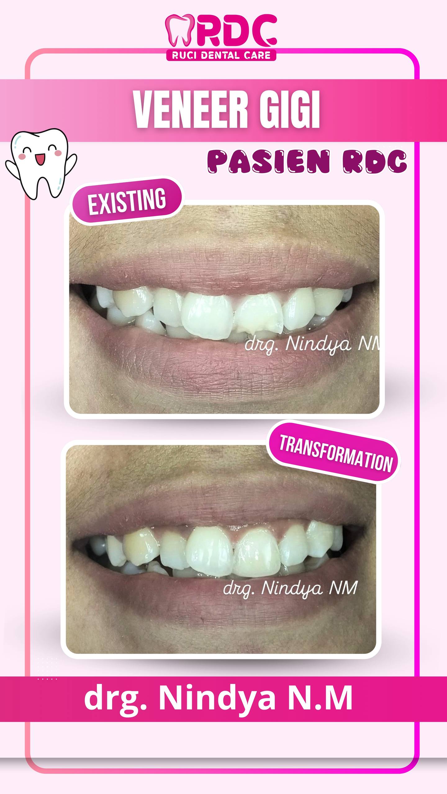Veneer Gigi