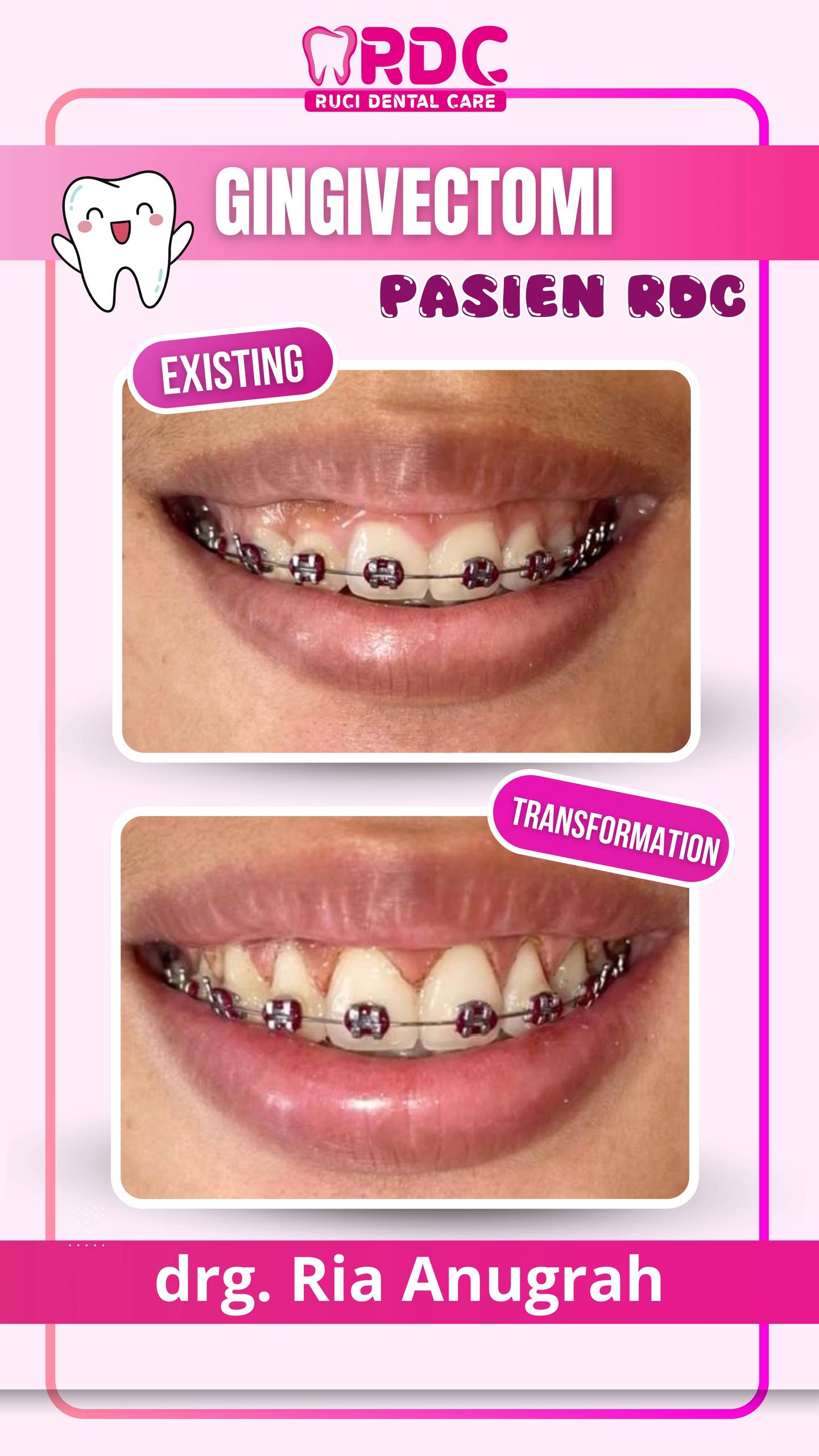 Gingivectomy / Potong Gusi