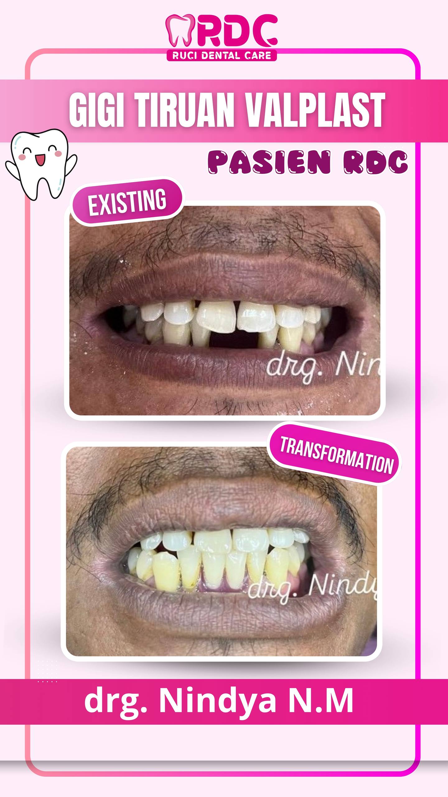 Gigi Tiruan