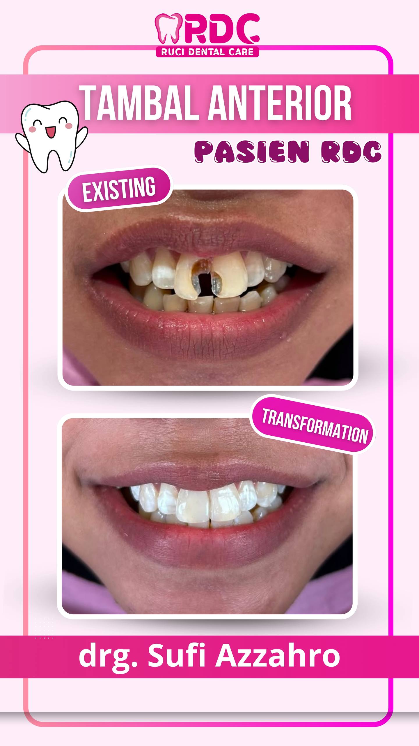 Tambal Gigi